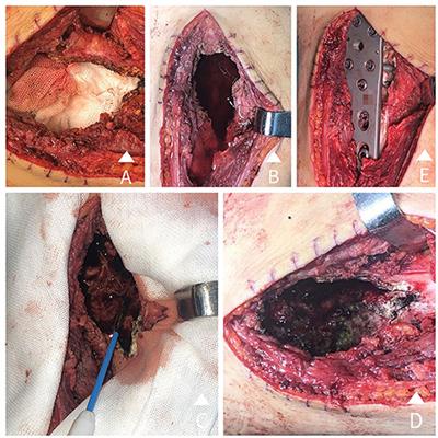 Management of the Cavity After Removal of Giant Cell Tumor of the Bone